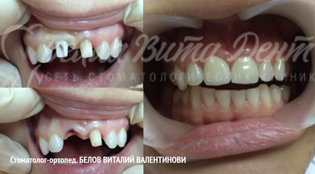 Удаление с одномоментной установкой и немедленной нагрузкой имплантата Nobel Biocare