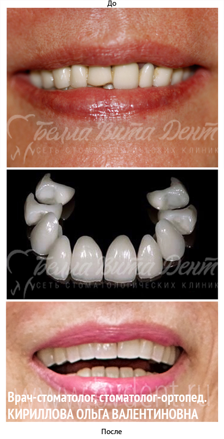 Безметалловые коронки